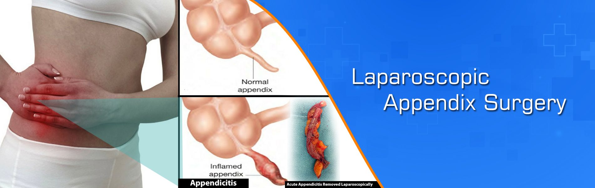 Best laparoscopic appendix surgery doctor in Jaipur